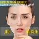 Лазерна плазмова ручка для видалення папілом та бородавок з 9 рівнями